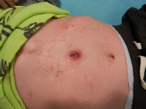 An angry g-tube site (stoma)